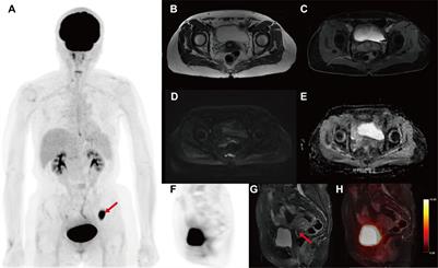 Incidental screening of descending colon carcinoma by 18F-FDG PET/MR imaging in a patient with endometrial carcinoma: A case report of Lynch syndrome